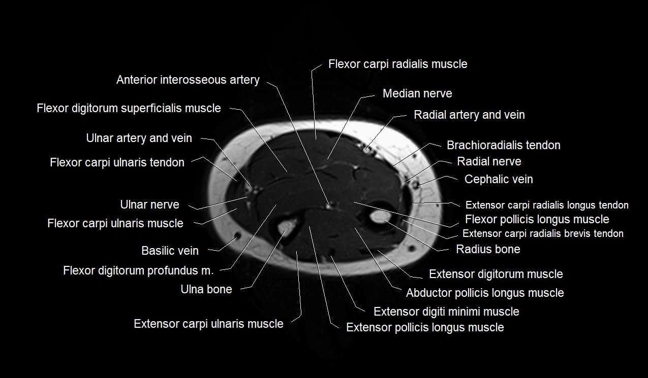 MRI 3T forearm axial cross sectional anatomy image 33.webp